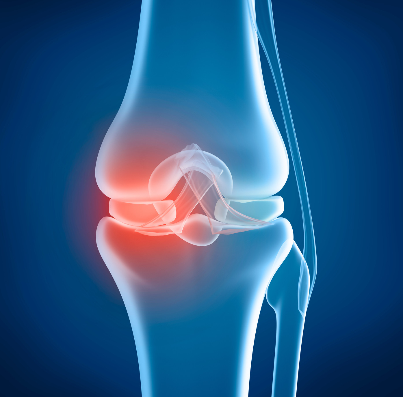Knee Replacement